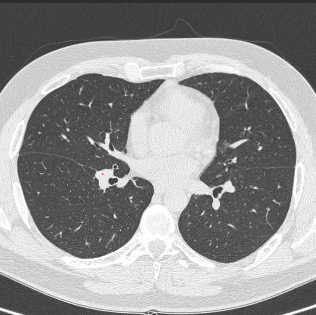 Пневмония, вызванная COVID-19: может ли компьютерная томография определить и спрогнозировать развитие болезни?